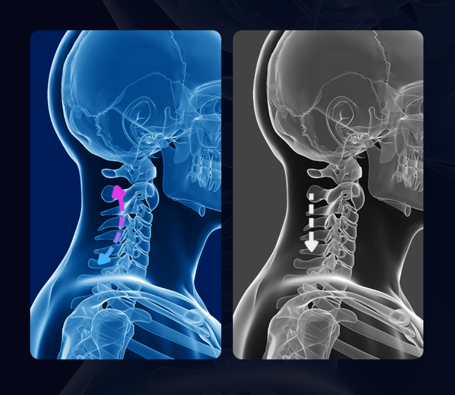 Tração cervical